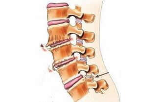 spondylarthrozė kaip nugaros skausmo priežastys