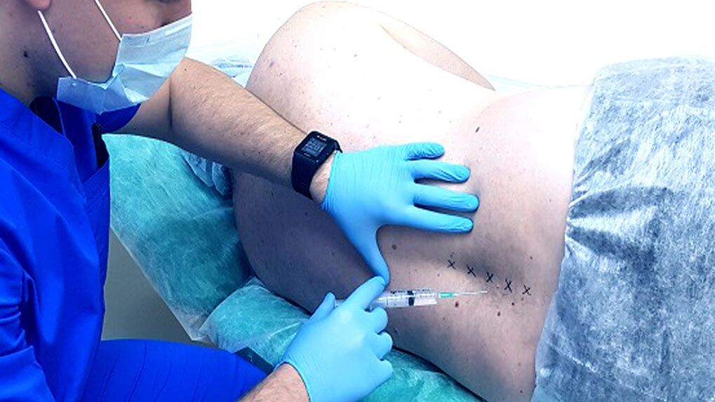 Stuburo blokas osteochondrozei