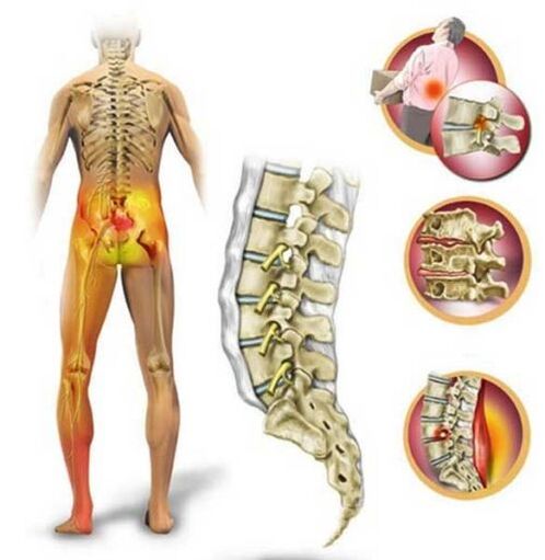 Juosmens stuburo osteochondrozė, sukelianti apatinės nugaros dalies skausmą